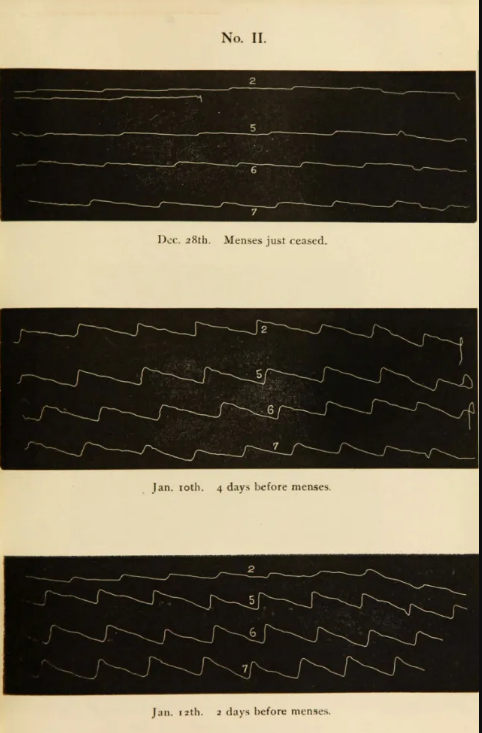 Dr. Mary Putnam’s measurements of the pulse by a sphygmograph, National Library of Medicine,